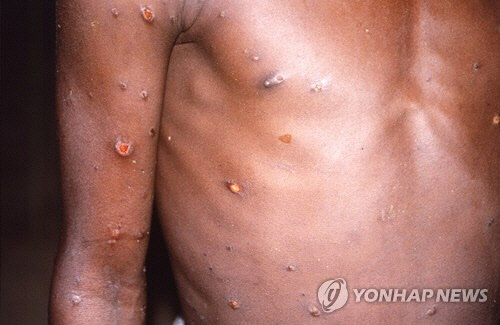 1996∼1997년 아프리카 콩고의 원숭이두창 환자[로이터=연합뉴스 자료사진]